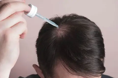 Clove Essential Oil For Alopecia Areata