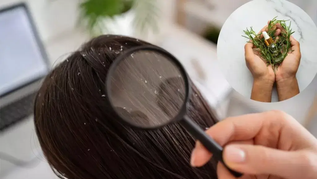 Rosemary Oil For Dandruff Control